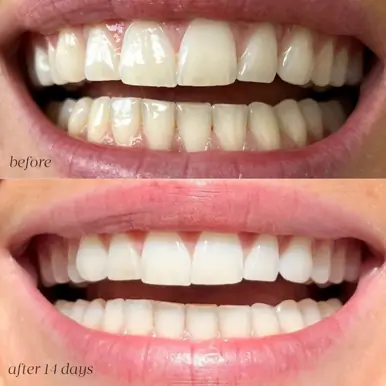 Gem Dissolvable Whitening Strips, 28 sachets