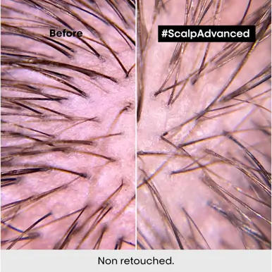 L'Oréal Professionnel Serie Expert Scalp Advanced Anti-Discomfort Treatment