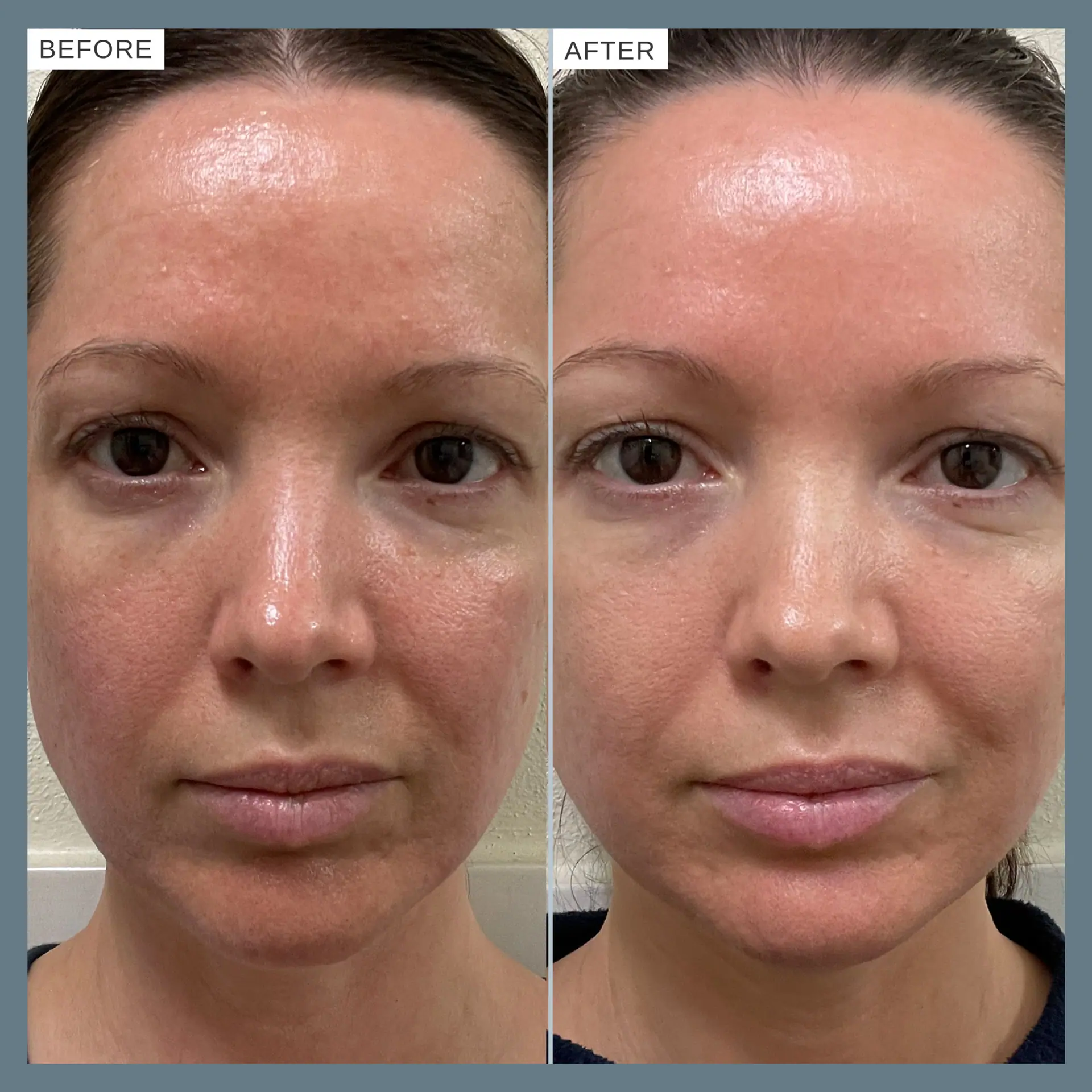 Alpha-H Vitamin B Serum with 0.5% Niacinamide 10ml